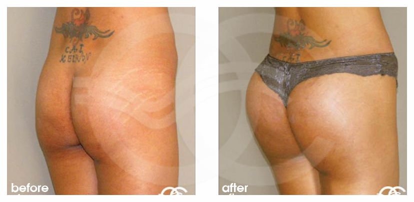 Buttock Augmentation Before After Gluteoplasty Marbella Ocean Clinic