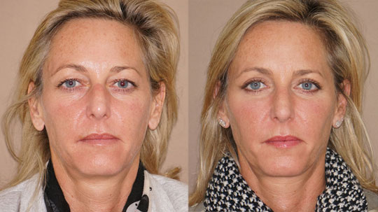 What does eyelid surgery entail? Ocean Clinic Marbella