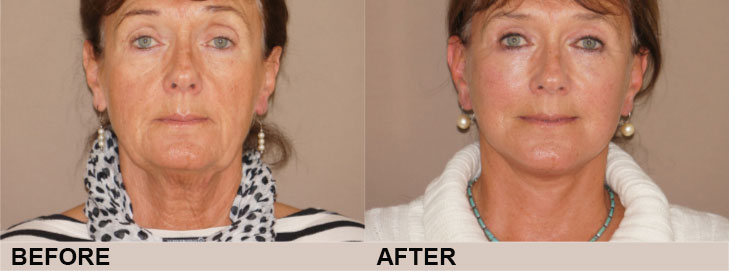 Considering a facelift? Before and after | Ocean Clinic Marbella