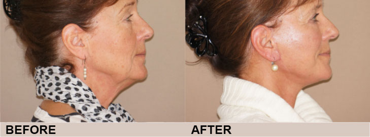 Considering a facelift? The recovery period | Ocean Clinic Marbella