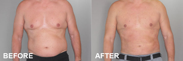 Addressing Enlarged Male Breast Tissue: Before and after | Ocean Clinic Marbella