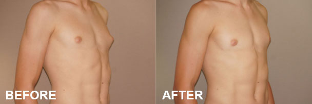 Addressing Enlarged Male Breast Tissue: Glandular Tissue Removal | Ocean Clinic Marbella