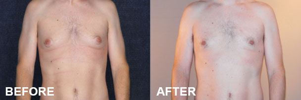 Addressing Enlarged Male Breast Tissue: Combination Procedures | Ocean Clinic Marbella