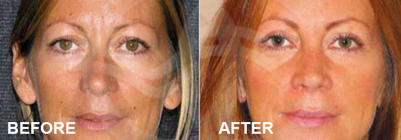 Blepharoplasty (Eyelid Surgery) Before and After | Marbella Ocean Clinic