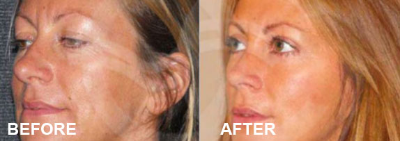 Upper and lower blepharoplasty Before and After | Marbella Ocean Clinic