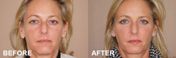 Non-Surgical Eye Rejuvenation Before and After | Marbella Ocean Clinic