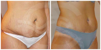 Tummy Tuck - Who is a good candidate? Body Contouring Abdominoplasty