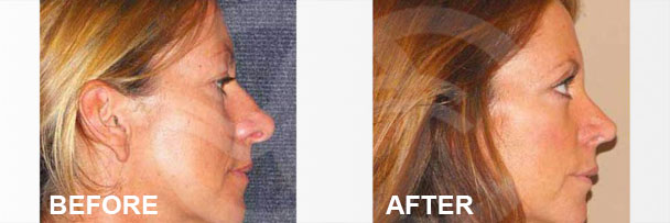 Facial Procedures Closed Rhinoplasty 1 | Ocean Clinic Marbella