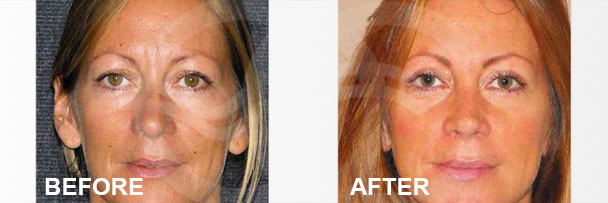 Facial Procedures Closed Rhinoplasty 2 | Ocean Clinic Marbella