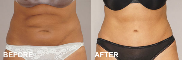 Body Contouring Procedures Abdominoplasty Before & after 1 | Ocean Clinic Marbella