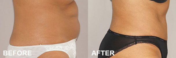 Body Contouring Procedures Abdominoplasty Before & after 2 | Ocean Clinic Marbella