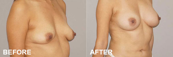 Breast Augmentation Fat Transfer Before & after 1 | Ocean Clinic Marbella