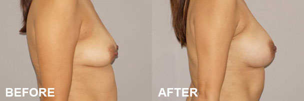 Breast Augmentation Fat Transfer Before & after 2 | Ocean Clinic Marbella