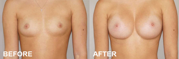 Breast Augmentation with Implants Before & after | Ocean Clinic Marbella