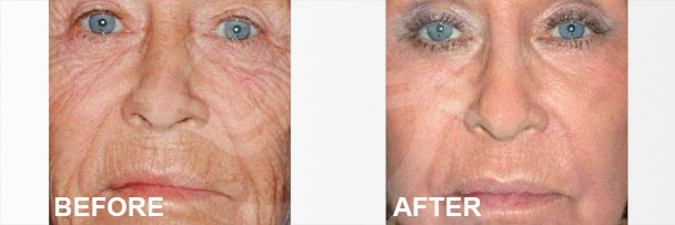 Skin Rejuvenation Treatments Deep Chemical Peeling 1 | Ocean Clinic Marbella