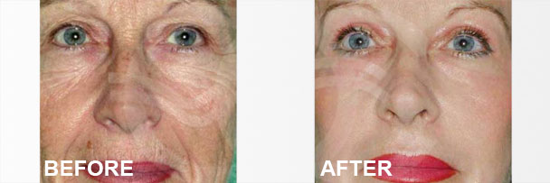 Skin Rejuvenation Treatments Deep Chemical Peeling 2 | Ocean Clinic Marbella