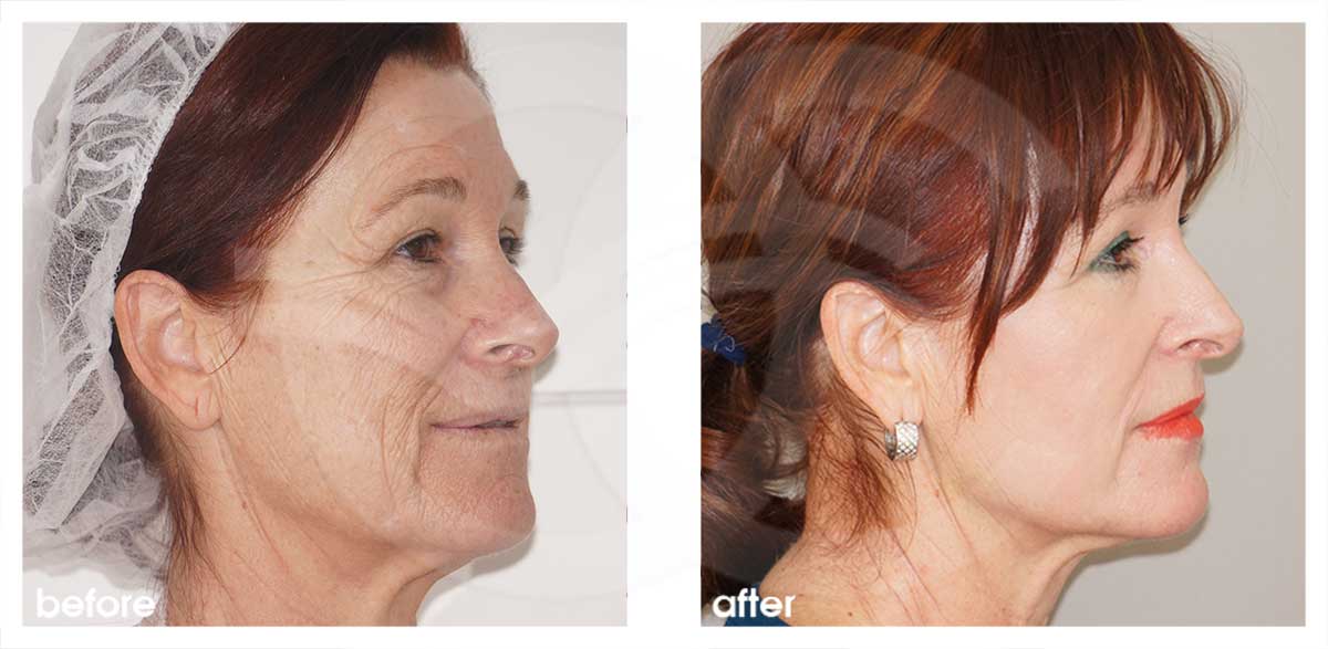 Chemisches Peeling Vorher Nachher Foto Ocean Clinic Marbella Spanien