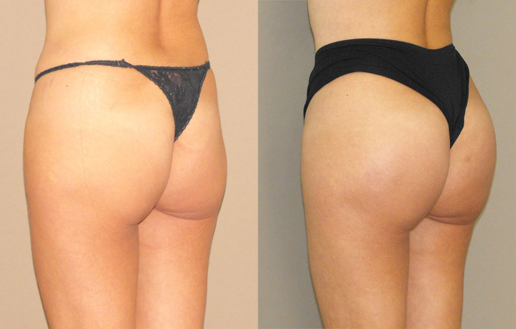 Maximizing Buttock Augmentation