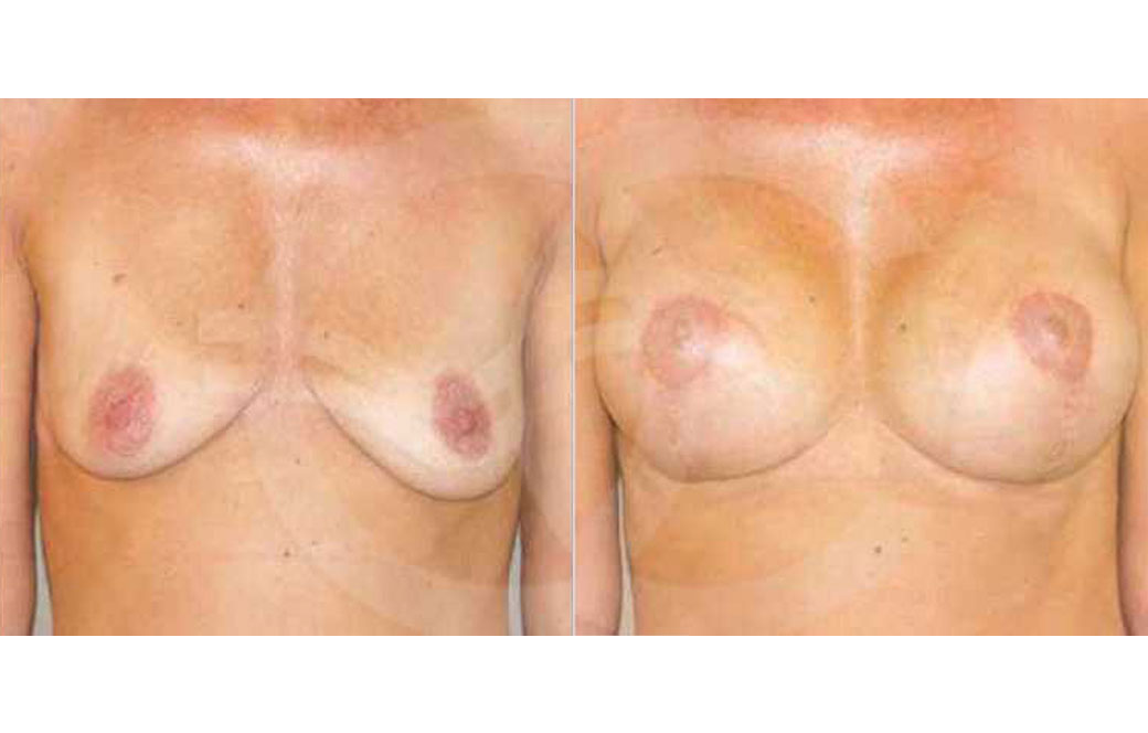 Breast lift Before & after 02 | Ocean Clinic Marbella