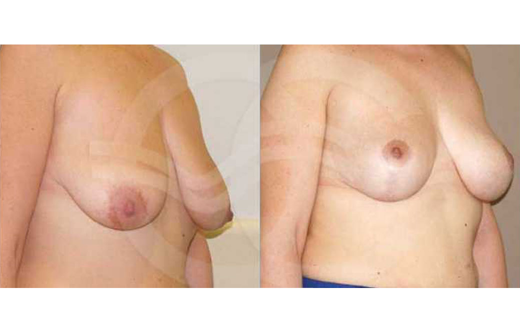 Breast lift Before & after 03 | Ocean Clinic Marbella