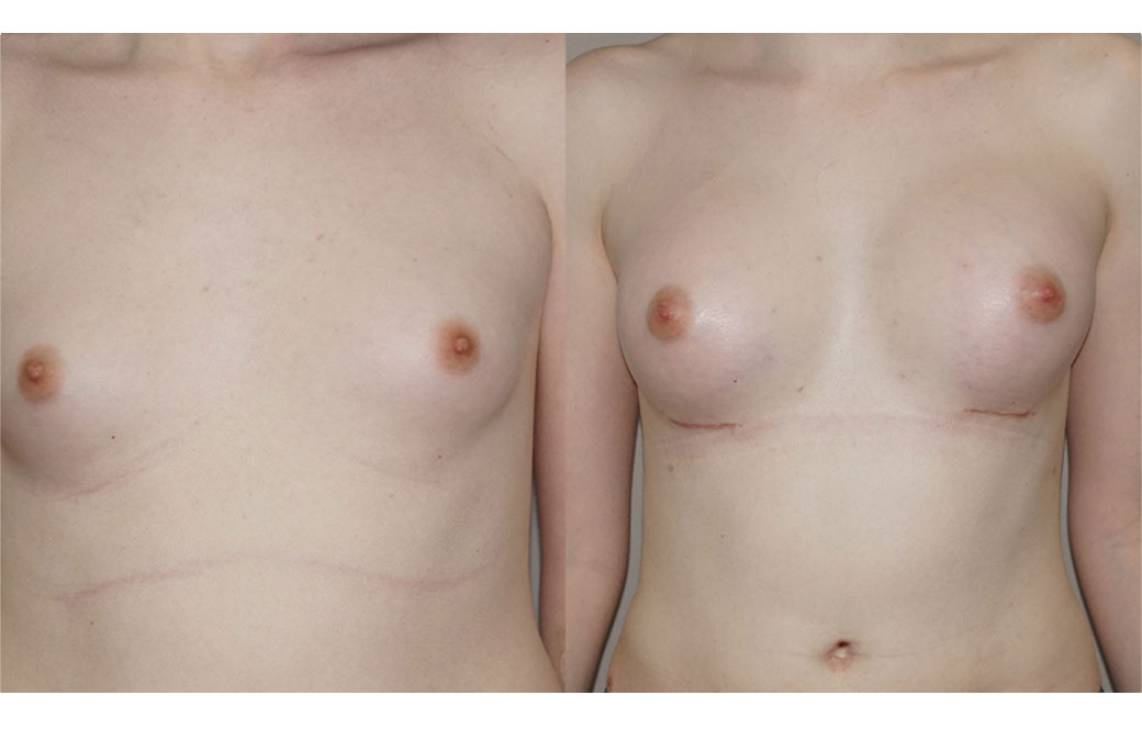 Photos Sex Reassignment Breast Augmentation I | Ocean Clinic Marbella