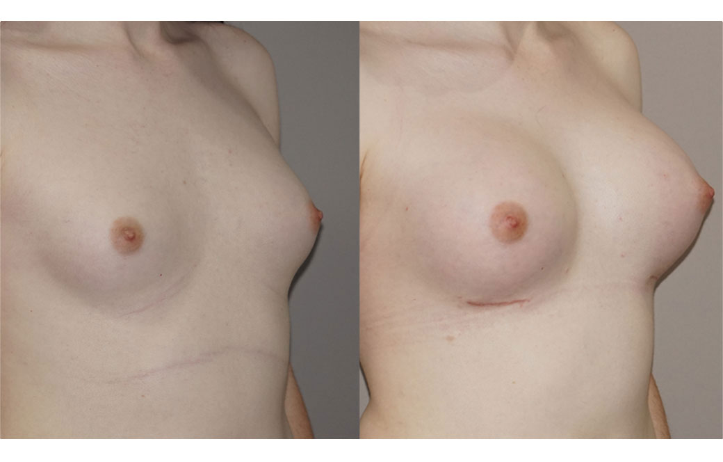 Photos Sex Reassignment Breast Augmentation II | Ocean Clinic Marbella