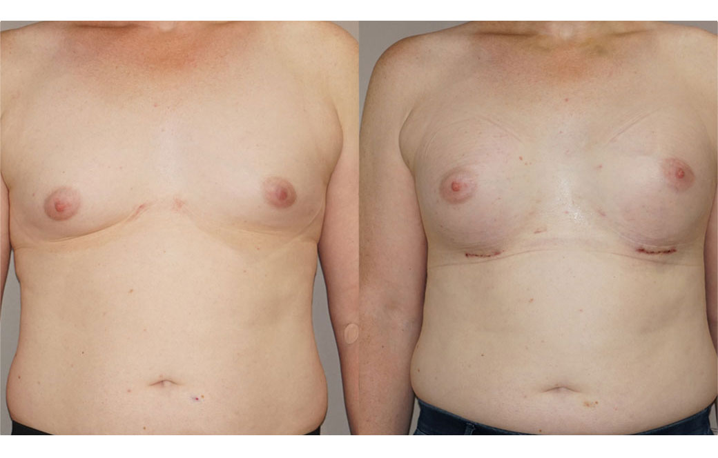 Photos Sex Reassignment Breast Augmentation IV | Ocean Clinic Marbella