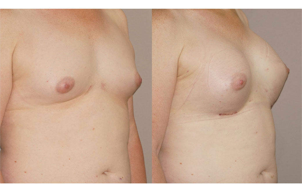 Photos Sex Reassignment Breast Augmentation V | Ocean Clinic Marbella