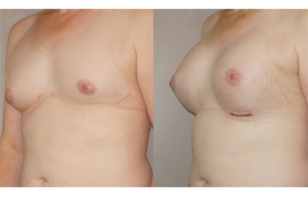 Photos Sex Reassignment Breast Augmentation VI | Ocean Clinic Marbella