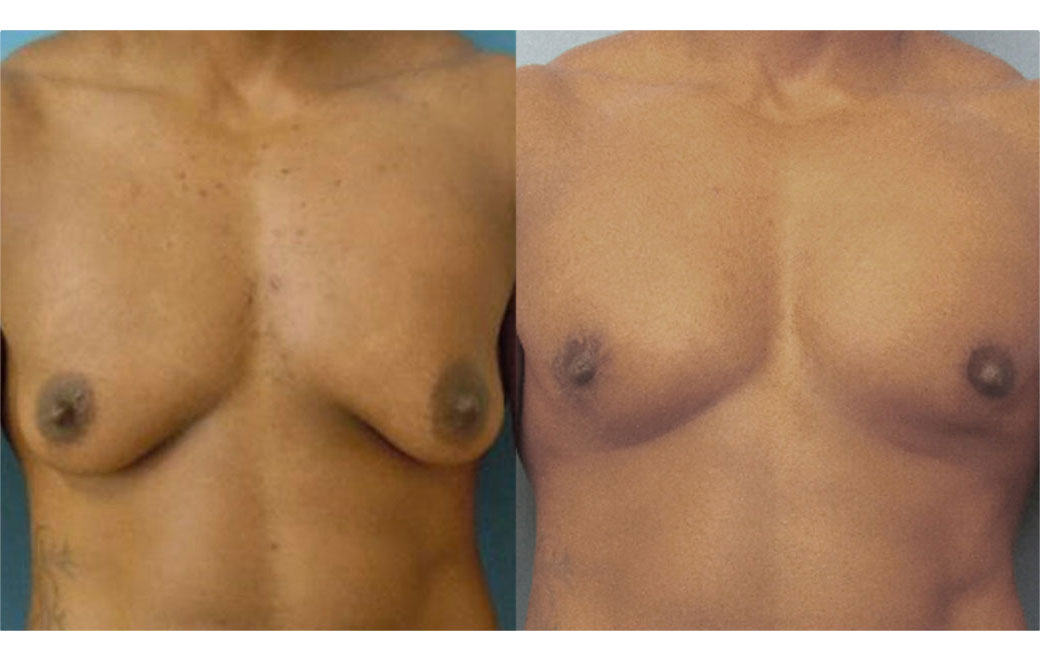 Photos Sex Reassignment Top Surgery - Mastectomy I | Ocean Clinic Marbella