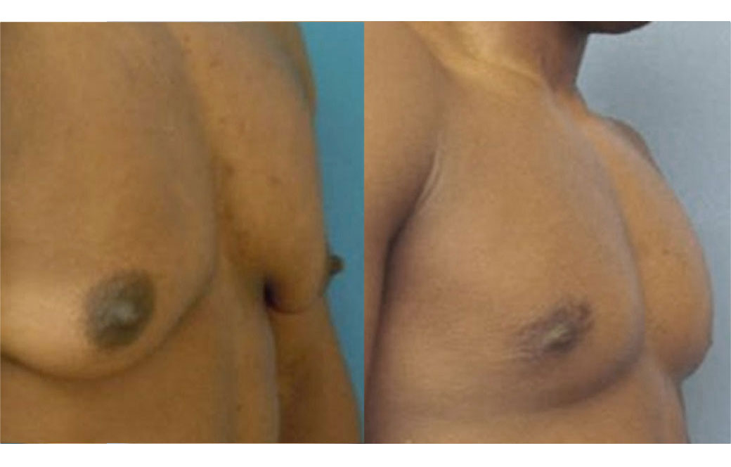 Photos Sex Reassignment Top Surgery - Mastectomy II | Ocean Clinic Marbella