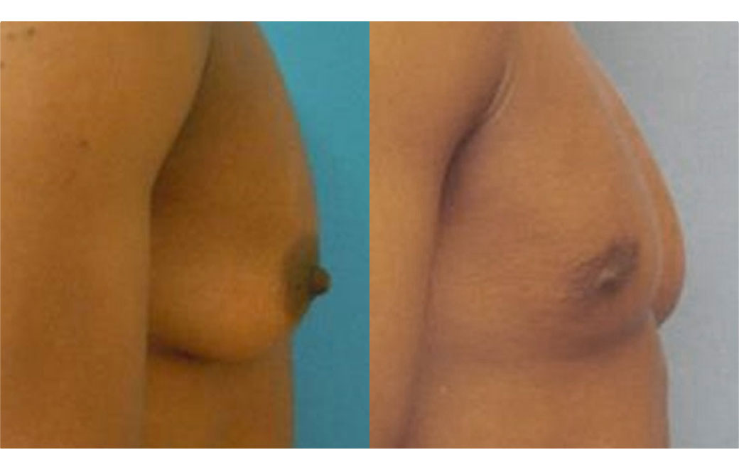 Photos Sex Reassignment Top Surgery - Mastectomy III | Ocean Clinic Marbella