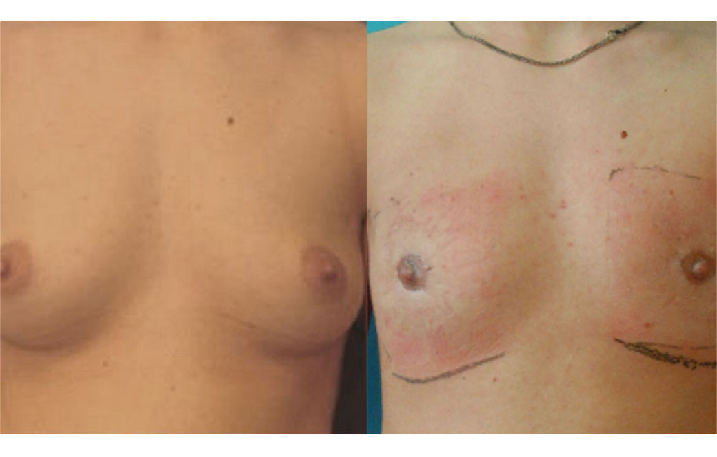 Photos Sex Reassignment Top Surgery - Mastectomy IV | Ocean Clinic Marbella