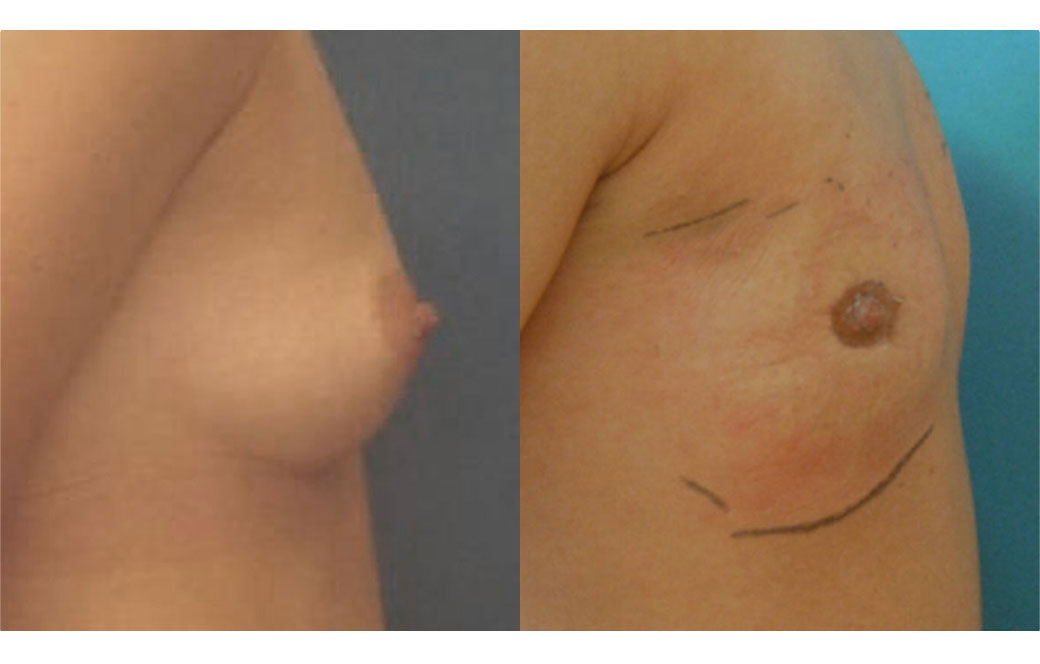 Photos Sex Reassignment Top Surgery - Mastectomy V | Ocean Clinic Marbella