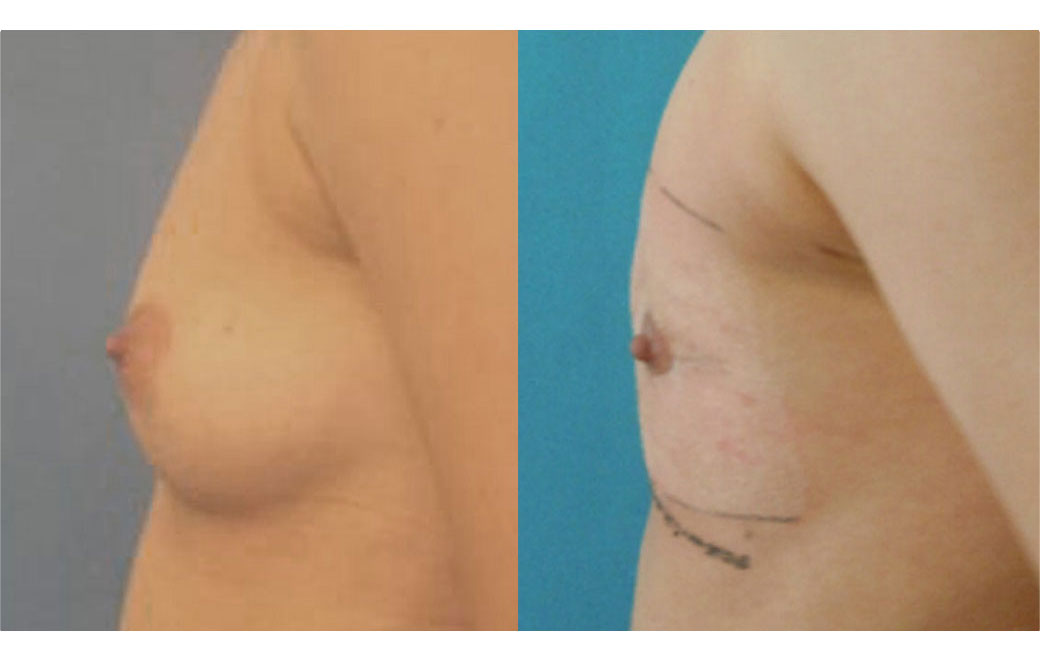 Photos Sex Reassignment Top Surgery - Mastectomy VI | Ocean Clinic Marbella