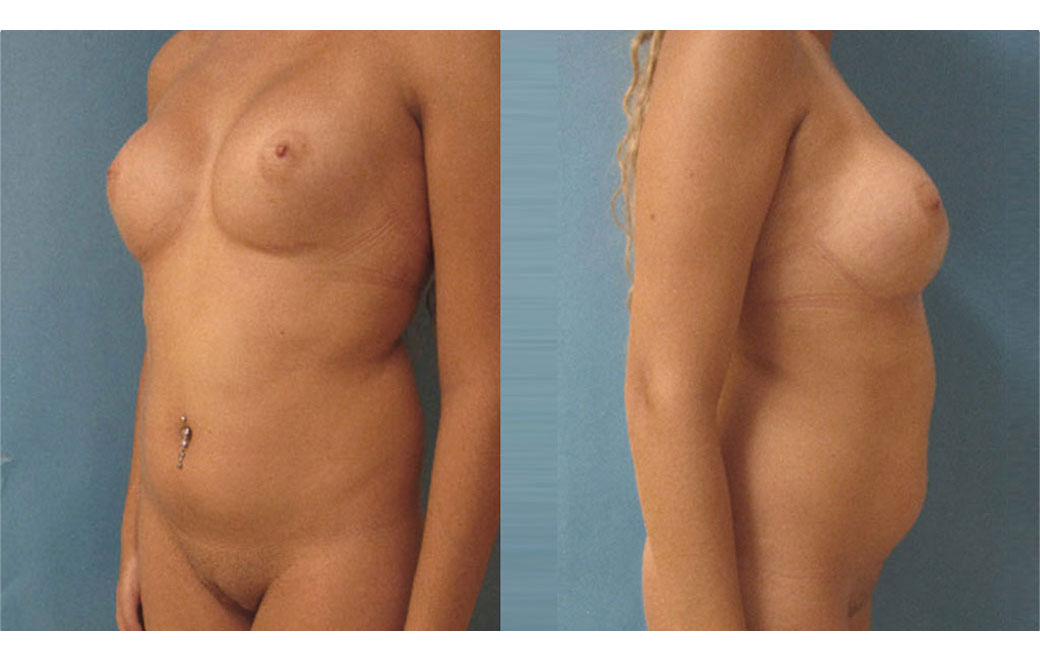 Photos Sex Reassignment Vaginoplasty II | Ocean Clinic Marbella