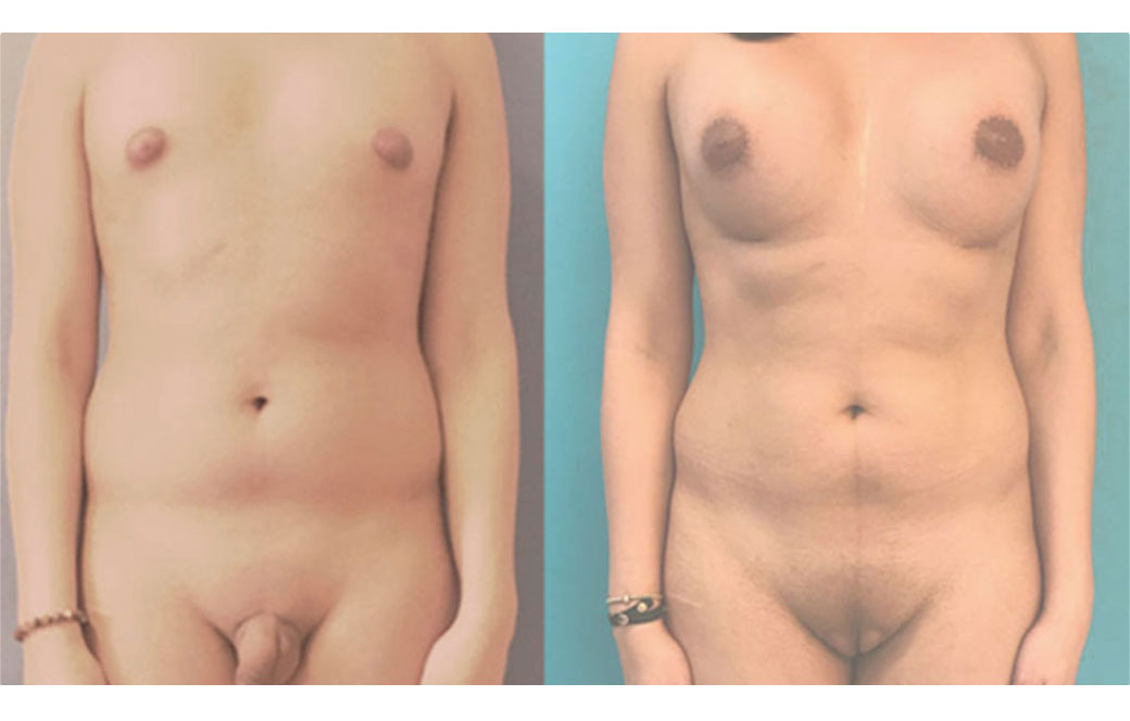 Photos Sex Reassignment Vaginoplasty III | Ocean Clinic Marbella